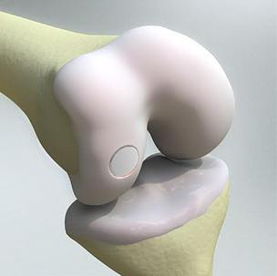 Bioploy implants
